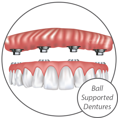 Dr. George Evans Offers A Variety of Dental Implant Options