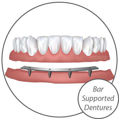 Dr. George Evans Offers A Variety of Dental Implant Options