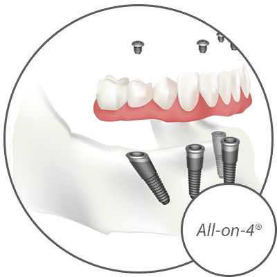 Dr. George Evans Offers A Variety of Dental Implant Options