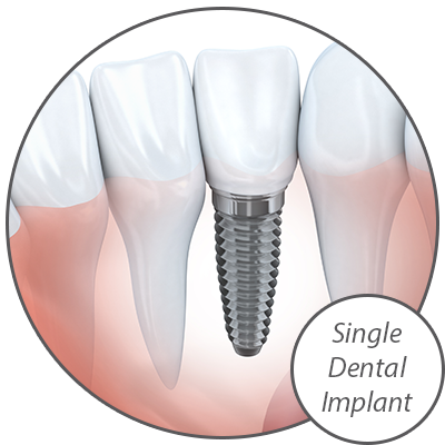 Dr. George Evans Offers A Variety of Dental Implant Options